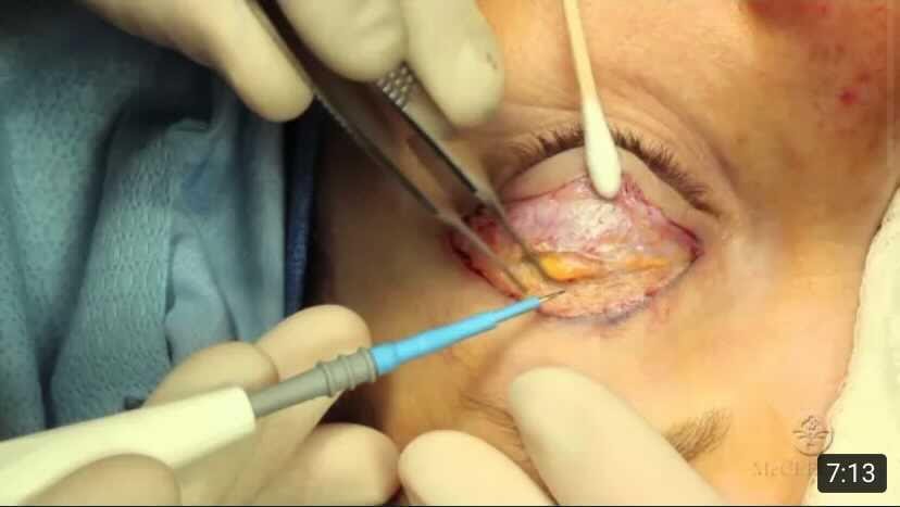 Vision Restoration Breakthrough